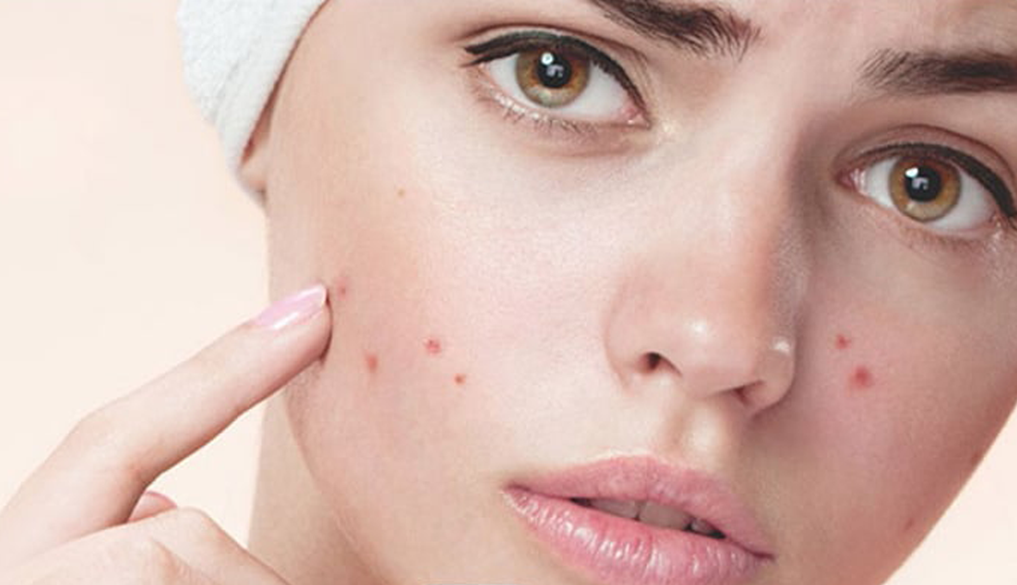 انواع لک پوستی قابل درمان 1 Treatment of facial blemishes