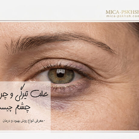 رازهای جوانی و درمان تیرگی و چروک دور چشم + راهنمای جامع 1 eyes wrinkles and dark circle blog2