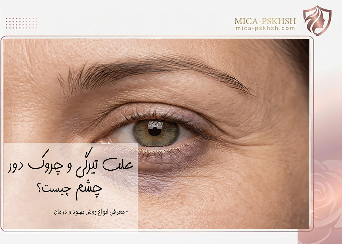 رازهای جوانی و درمان تیرگی و چروک دور چشم + راهنمای جامع 1 eyes wrinkles and dark circle blog2